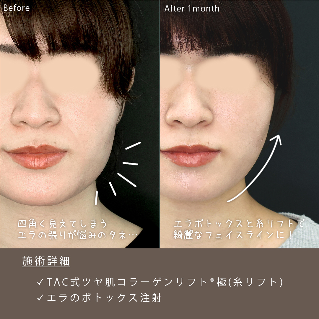 TAC式 ツヤ肌コラーゲンリフト®/エラボトックス注射の症例写真 施術前後 