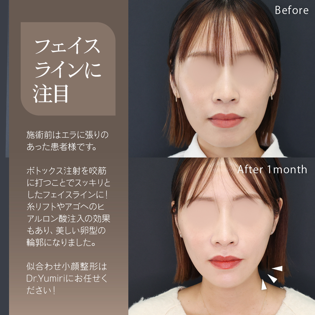 TAC式 ツヤ肌コラーゲンリフト®/エラボトックス注射/ボトックス注射：その他の症例写真 施術前後 