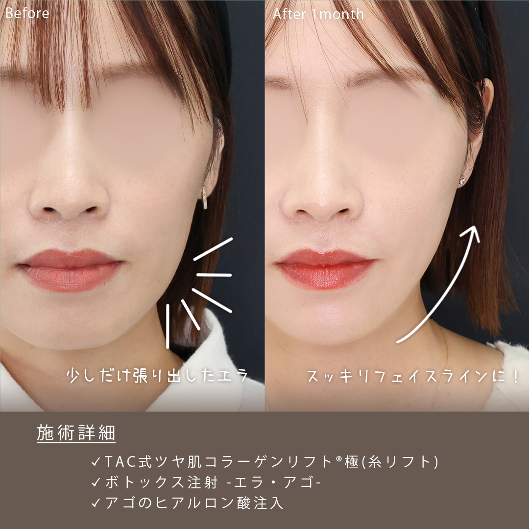 TAC式 ツヤ肌コラーゲンリフト®/エラボトックス注射/ボトックス注射：その他の症例写真 施術前後 