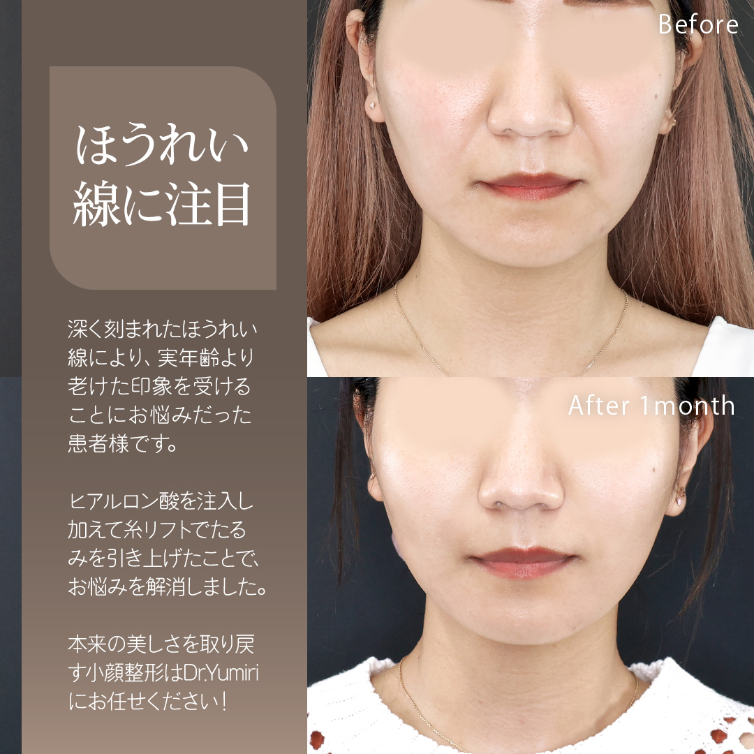 TAC式 ツヤ肌コラーゲンリフト®/ほうれい線のヒアルロン酸注射の症例写真 施術前後