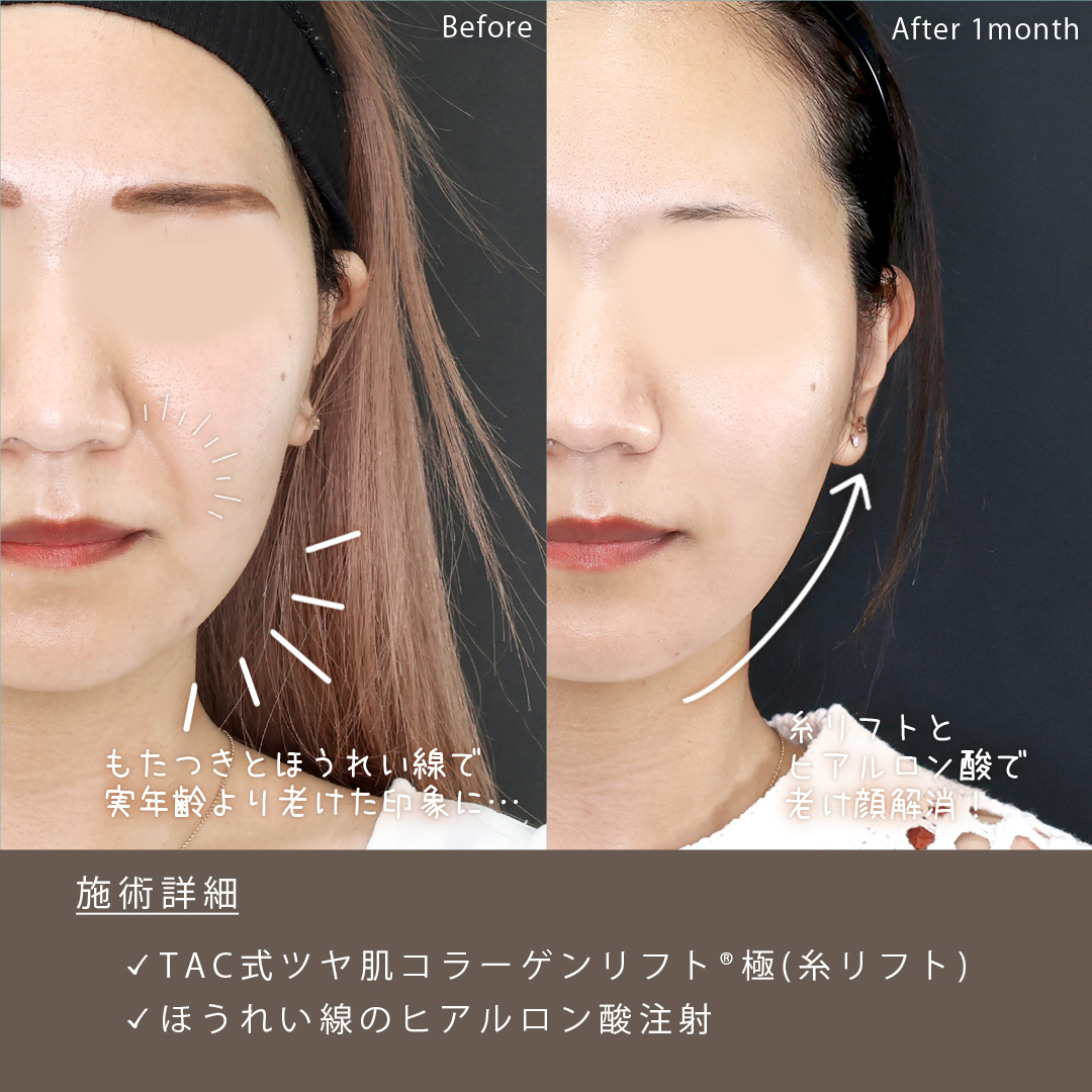 TAC式 ツヤ肌コラーゲンリフト®/ほうれい線のヒアルロン酸注射の症例写真 施術前後