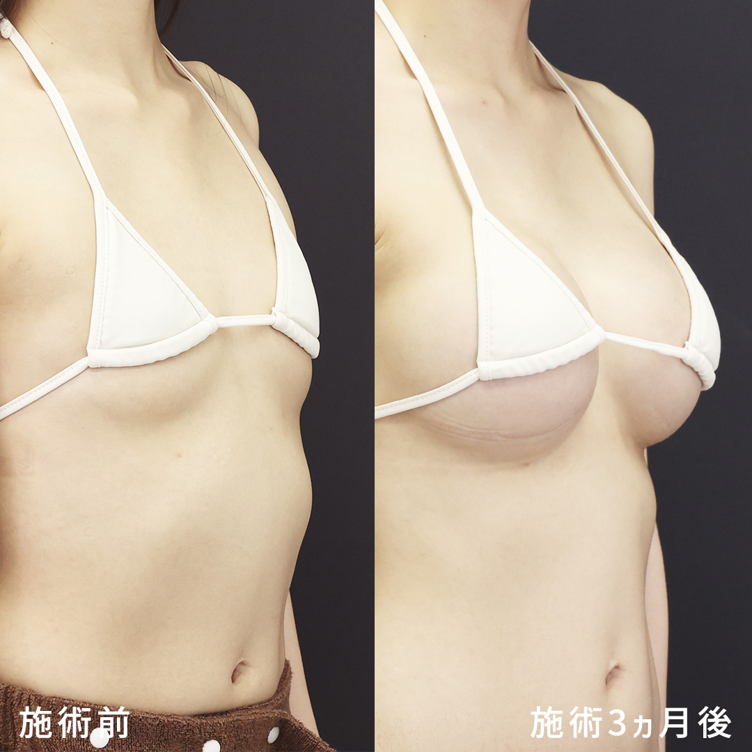 【シリコンバッグ豊胸】理想のサイズアップ｜形成外科専門医が執刀