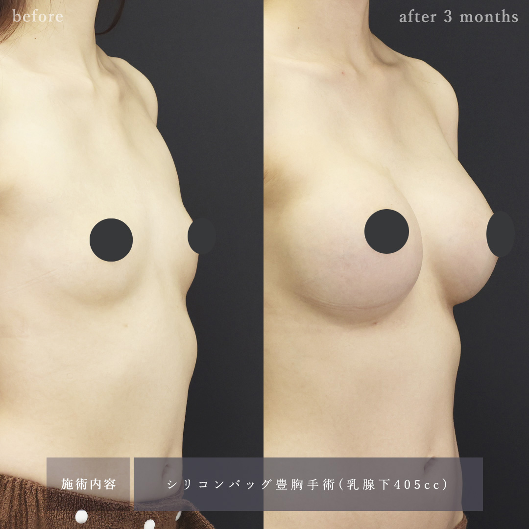 シリコンバッグ豊胸（人工乳腺バッグ）の症例写真 施術前後 