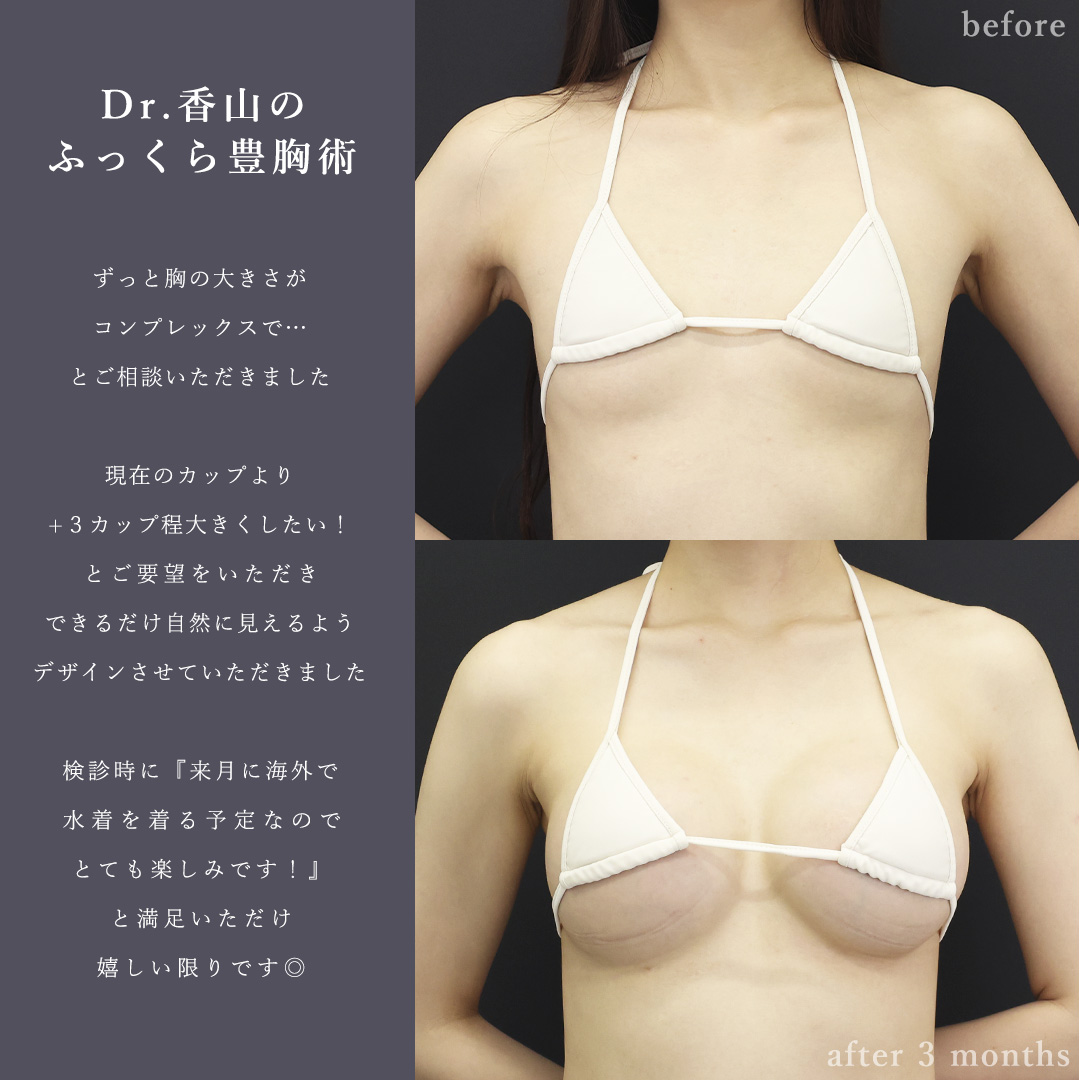 シリコンバッグ豊胸（人工乳腺バッグ）の症例写真 施術前後 