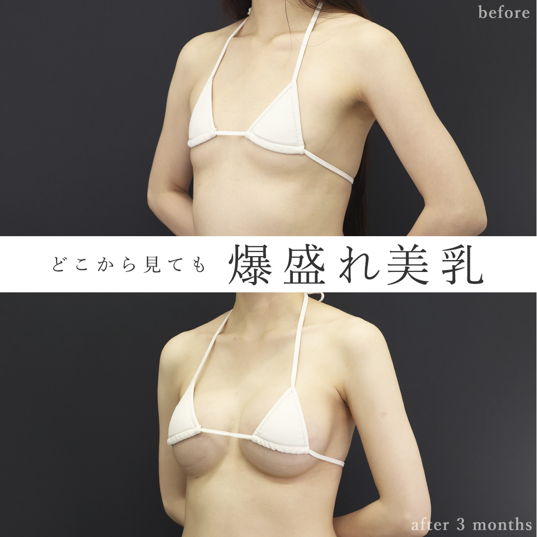 シリコンバッグ豊胸（人工乳腺バッグ）の症例写真 施術前後 