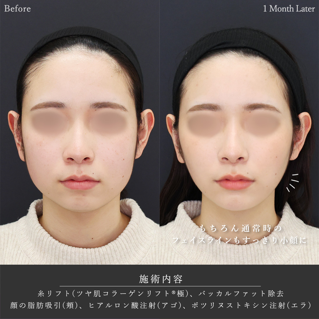 TAC式 ツヤ肌コラーゲンリフト®/バッカルファット除去/顔の脂肪吸引の症例写真 施術前後 