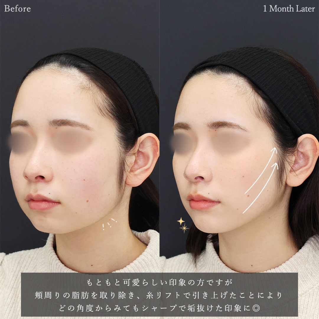 TAC式 ツヤ肌コラーゲンリフト®/バッカルファット除去/顔の脂肪吸引の症例写真 施術前後 