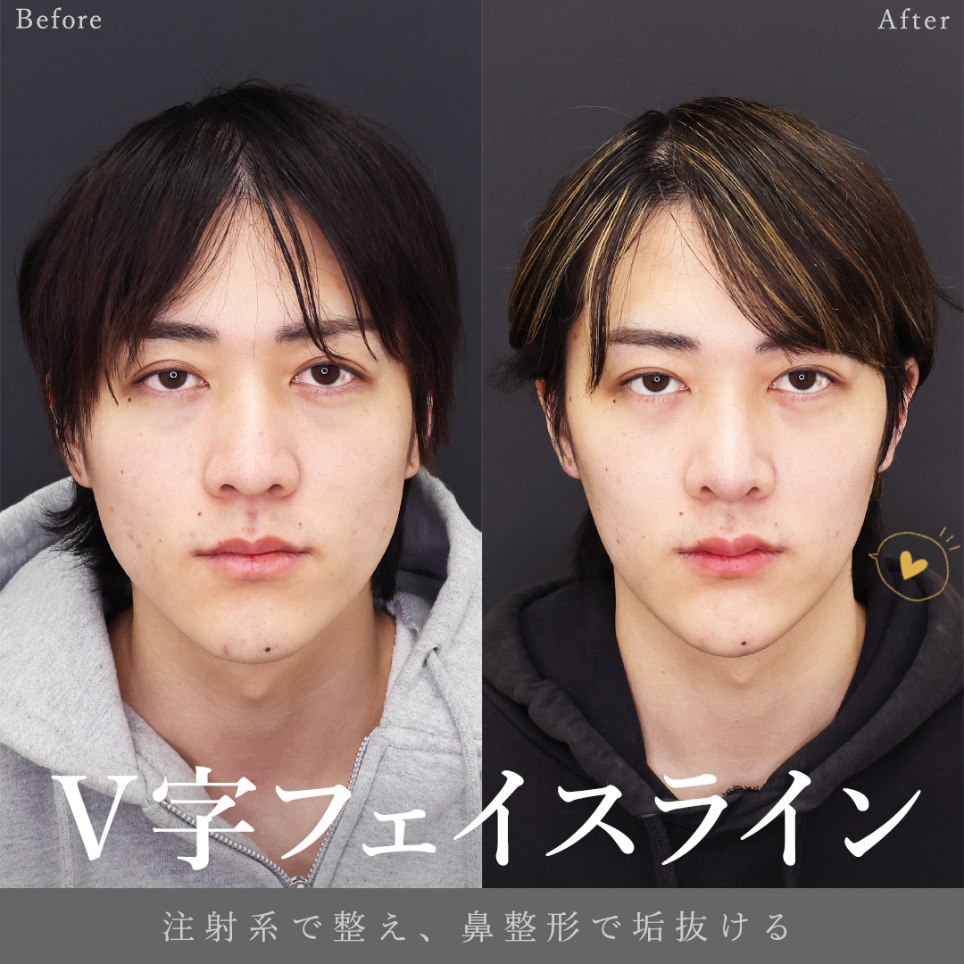 鼻中隔延長術/鼻尖形成・鼻尖縮小/鼻先軟骨移植の症例写真 施術前後 