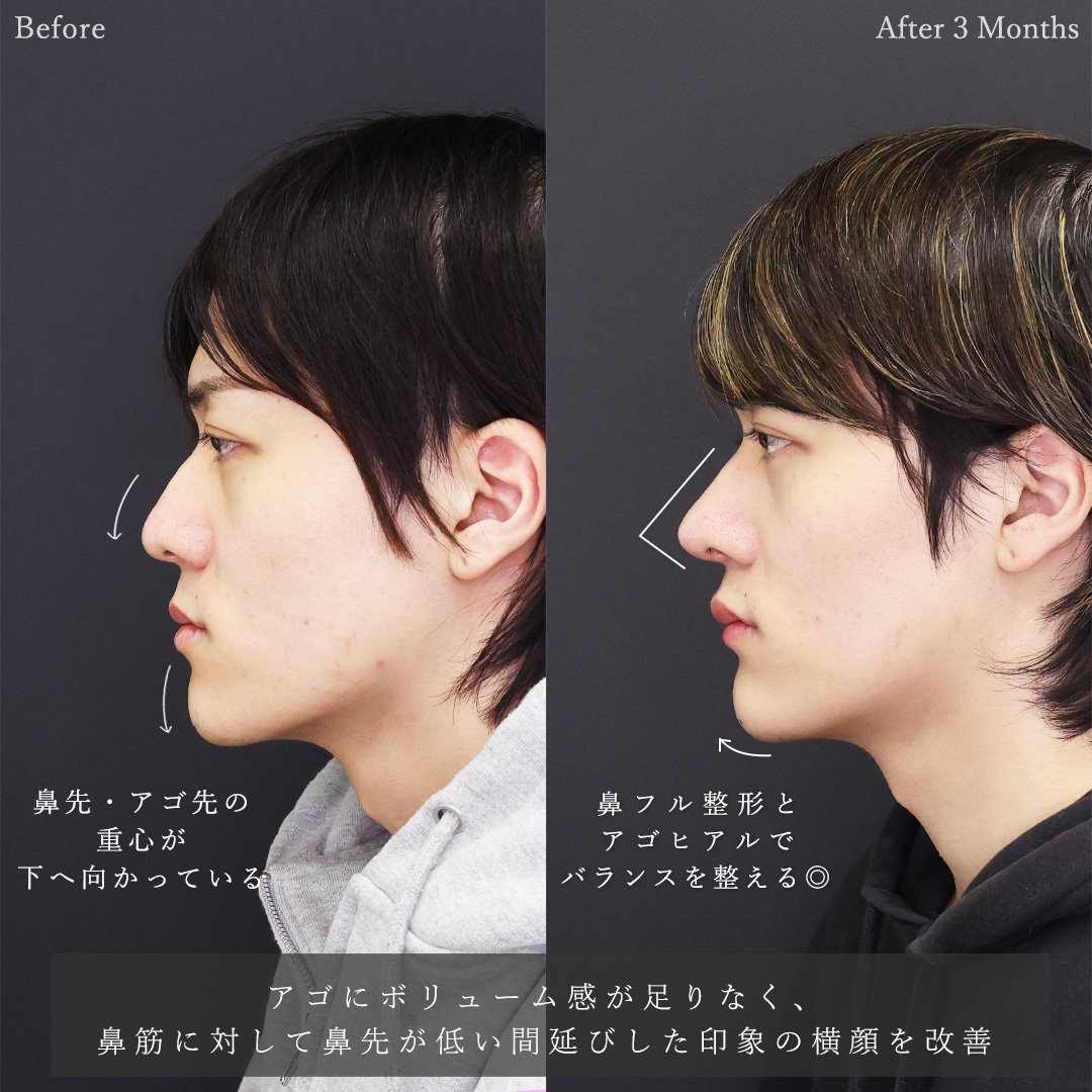 鼻中隔延長術/鼻尖形成・鼻尖縮小/鼻先軟骨移植の症例写真 施術前後 