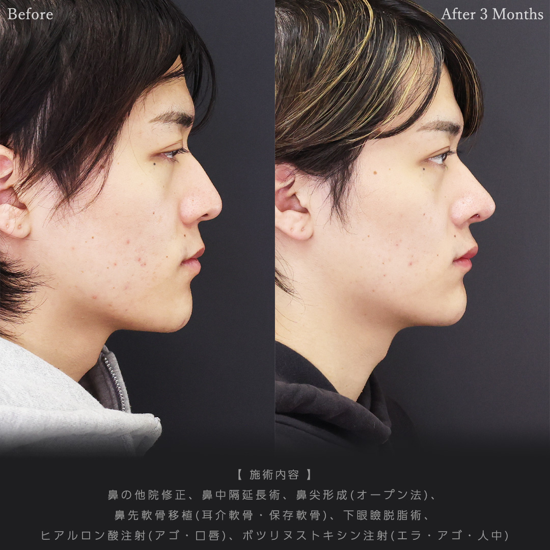 鼻中隔延長術/鼻尖形成・鼻尖縮小/鼻先軟骨移植の症例写真 施術前後 