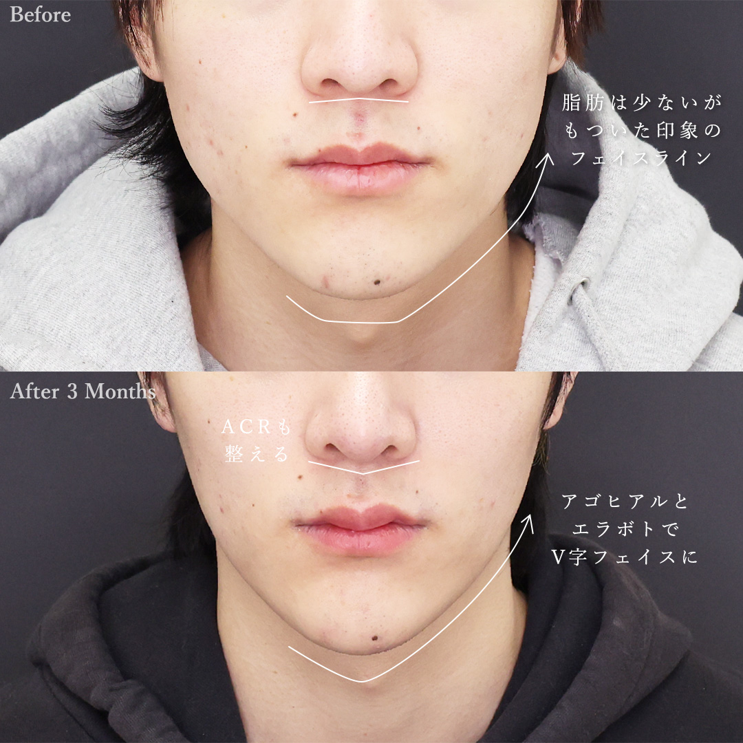 鼻中隔延長術/鼻尖形成・鼻尖縮小/鼻先軟骨移植の症例写真 施術前後 