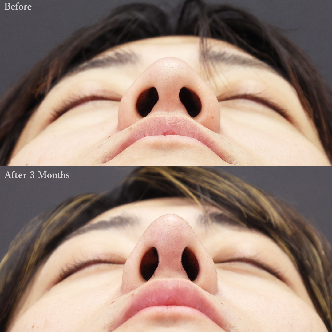 鼻中隔延長術/鼻尖形成・鼻尖縮小/鼻先軟骨移植の症例写真 施術前後 