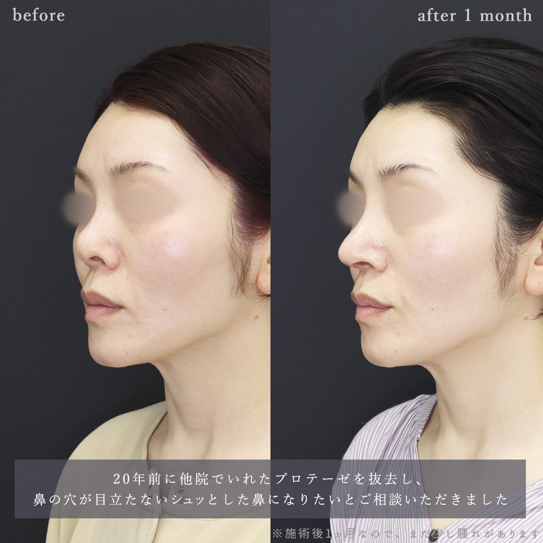 鼻中隔延長術/鼻尖形成・鼻尖縮小/鼻先軟骨移植の症例写真 施術前後 