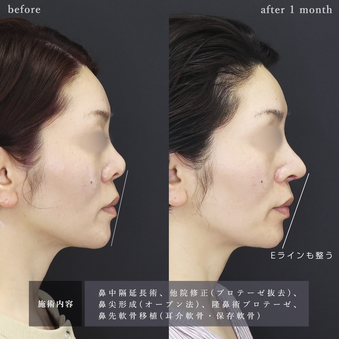 鼻中隔延長術/鼻尖形成・鼻尖縮小/鼻先軟骨移植の症例写真 施術前後 
