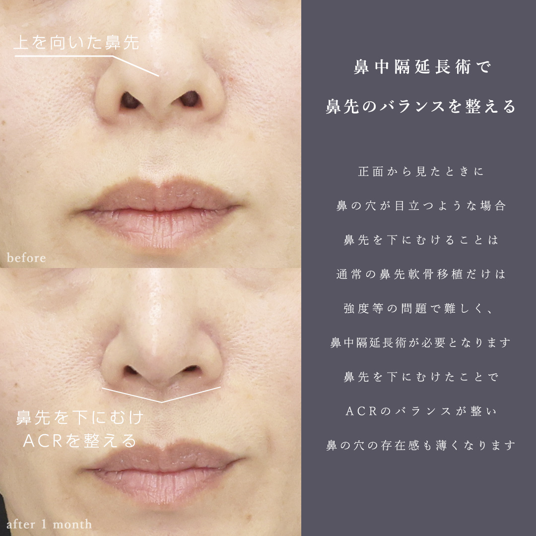 鼻中隔延長術/鼻尖形成・鼻尖縮小/鼻先軟骨移植の症例写真 施術前後 