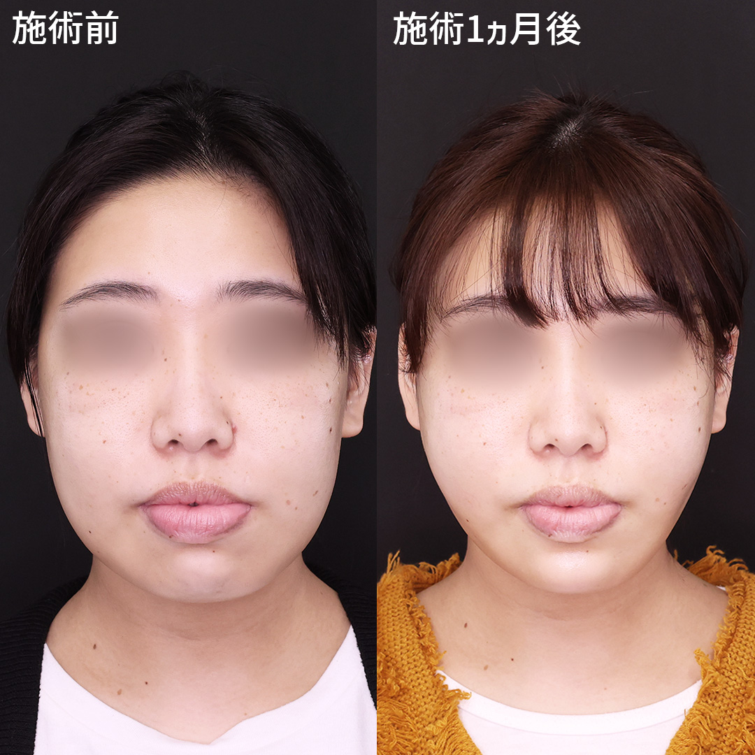 悩みだった四角い輪郭…【糸リフト】でシャープに！