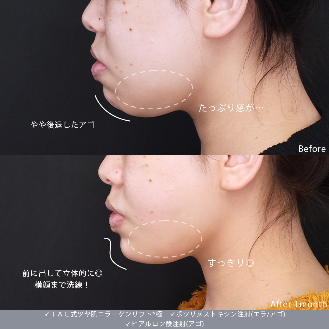 TAC式 ツヤ肌コラーゲンリフト®/エラボトックス注射/ボトックス注射：その他の症例写真 施術前後 