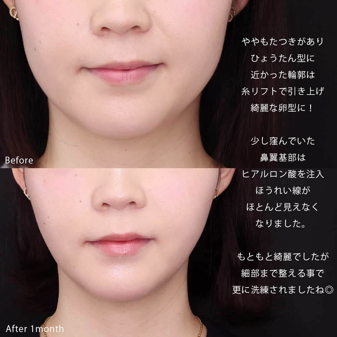 TAC式 ツヤ肌コラーゲンリフト®/Lラインファット除去（エラ下脂肪除去）/エラボトックス注射の症例写真 施術前後 