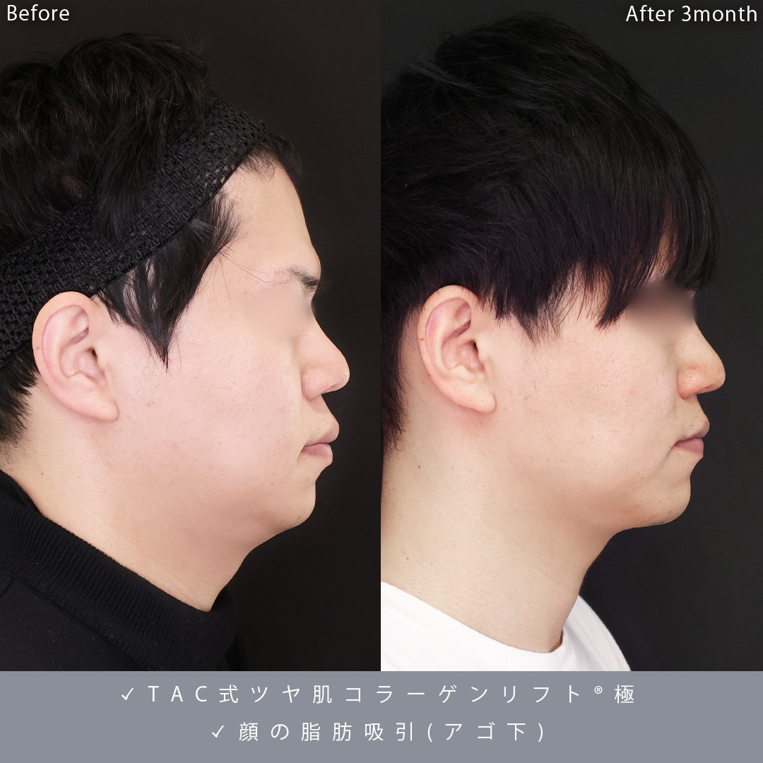顎下の脂肪吸引/TAC式 ツヤ肌コラーゲンリフト®の症例写真 施術前後 