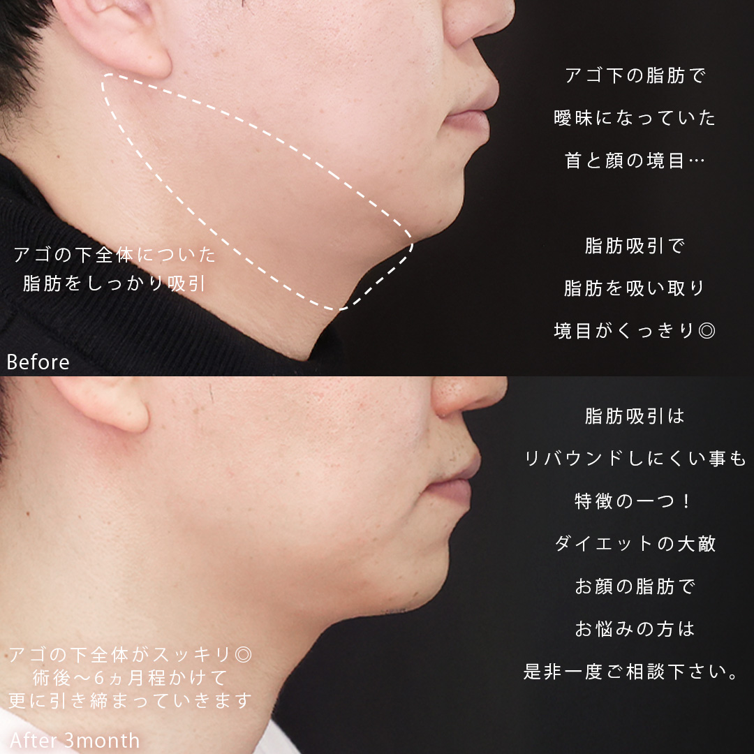 顎下の脂肪吸引/TAC式 ツヤ肌コラーゲンリフト®の症例写真 施術前後 