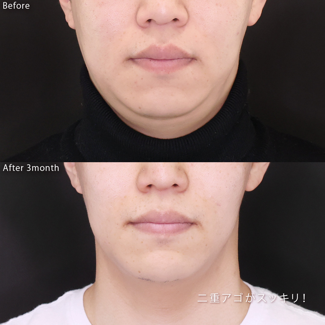 顎下の脂肪吸引/TAC式 ツヤ肌コラーゲンリフト®の症例写真 施術前後 