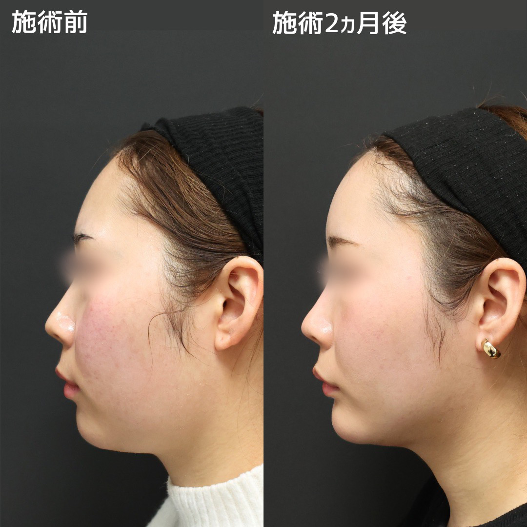 TAC式 ツヤ肌コラーゲンリフト®/ジョールファット除去/Lラインファット除去(エラ下脂肪除去)の症例写真 施術前後