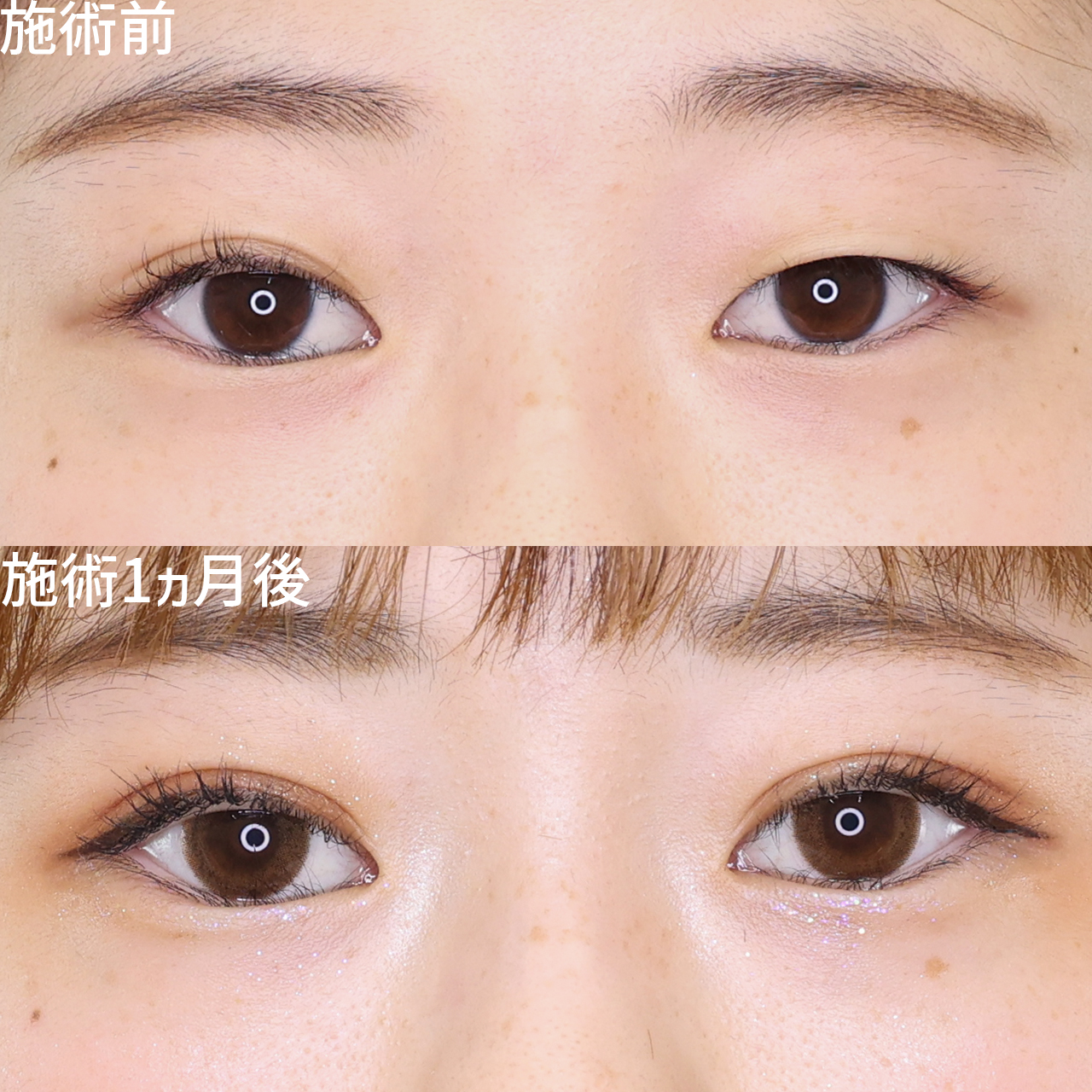 二重埋没法の症例写真 施術前後 