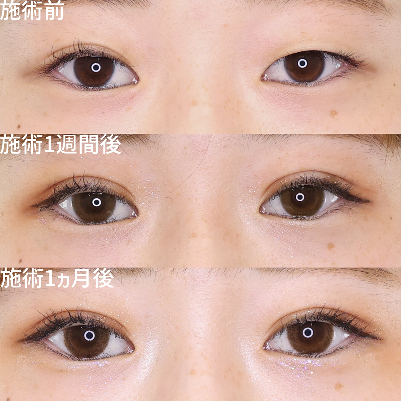 二重埋没法の症例写真 施術前後 