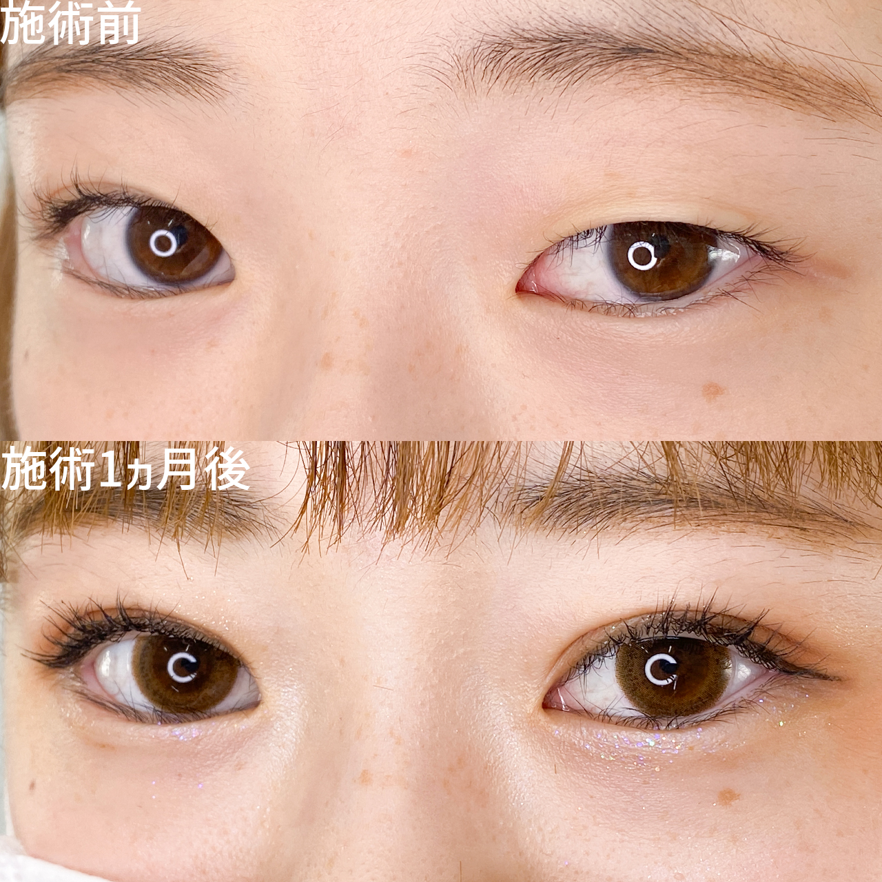 二重埋没法の症例写真 施術前後 