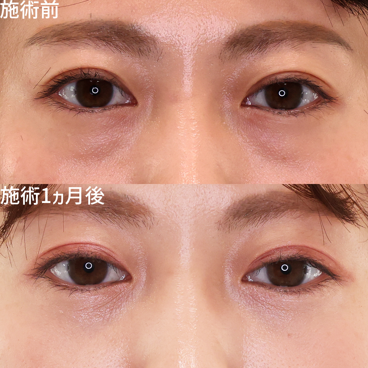 直後から綺麗！目の下のクマ・ふくらみ取りで明るい目元に♪