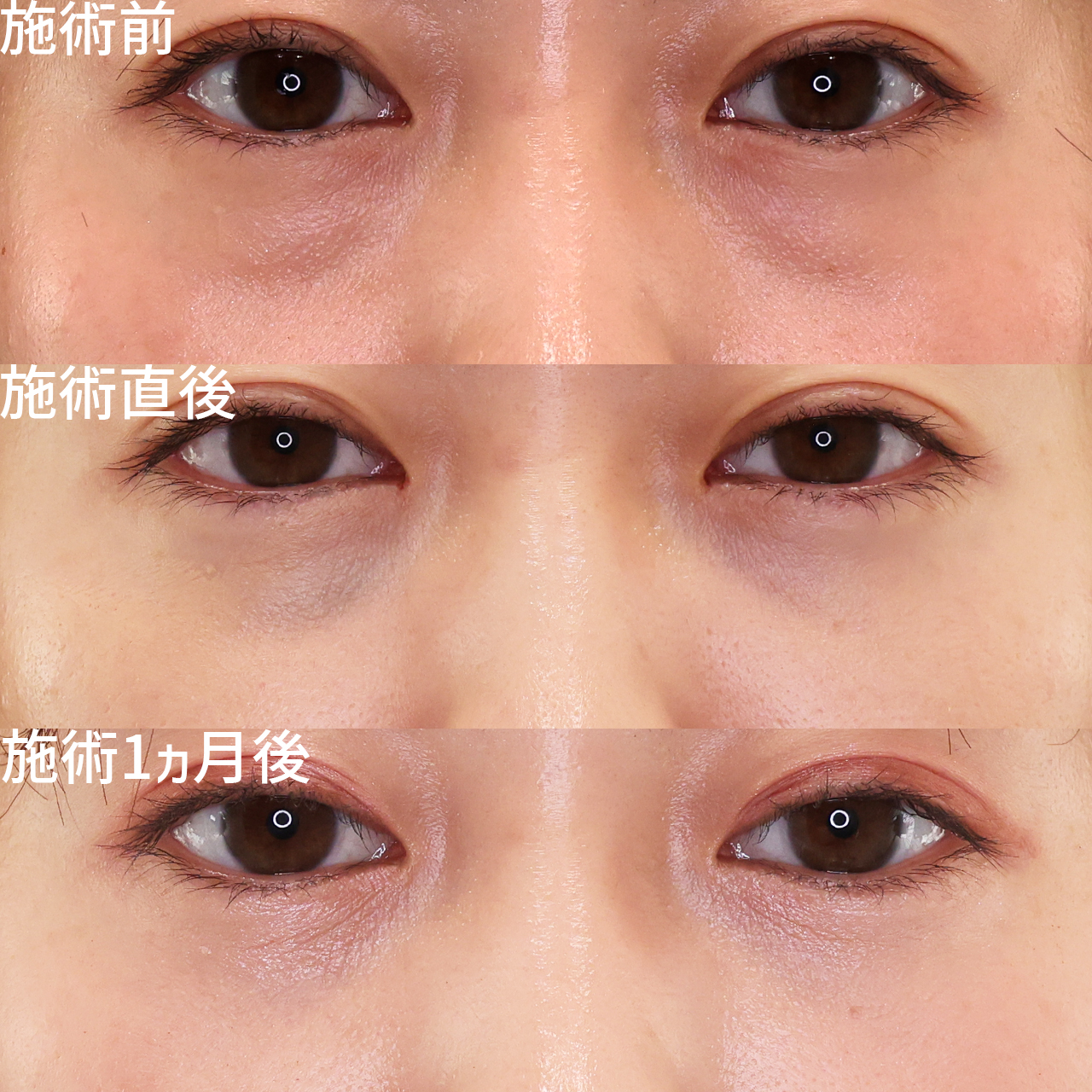 下眼瞼脱脂術（目の下のたるみ取り・目の下の脂肪ふくらみ取り）/顔の脂肪注入(コンデンスリッチフェイス)の症例写真 施術前後 