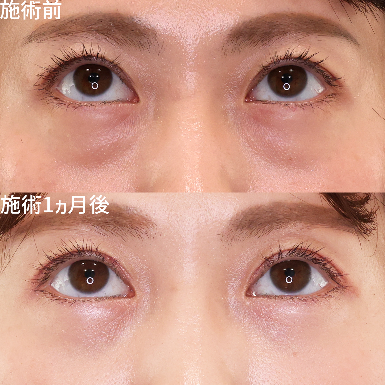 下眼瞼脱脂術（目の下のたるみ取り・目の下の脂肪ふくらみ取り）/顔の脂肪注入(コンデンスリッチフェイス)の症例写真 施術前後 