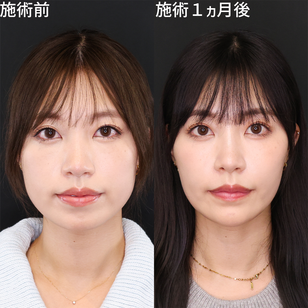 大人気レースクイーンさんご来院♡スッキリとさらに美しいフェイスラインに