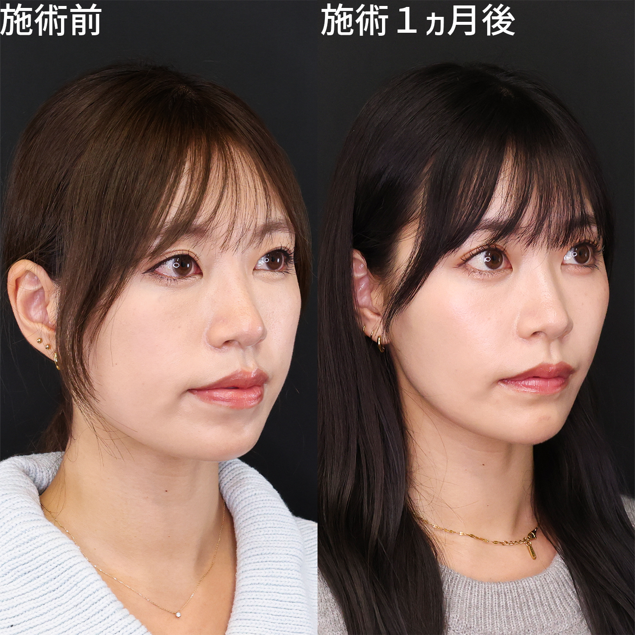 小顔整形｜パーフェクトフェイスライン/TAC式 ツヤ肌コラーゲンリフト®/Lラインファット除去（エラ下脂肪除去）の症例写真 施術前後 