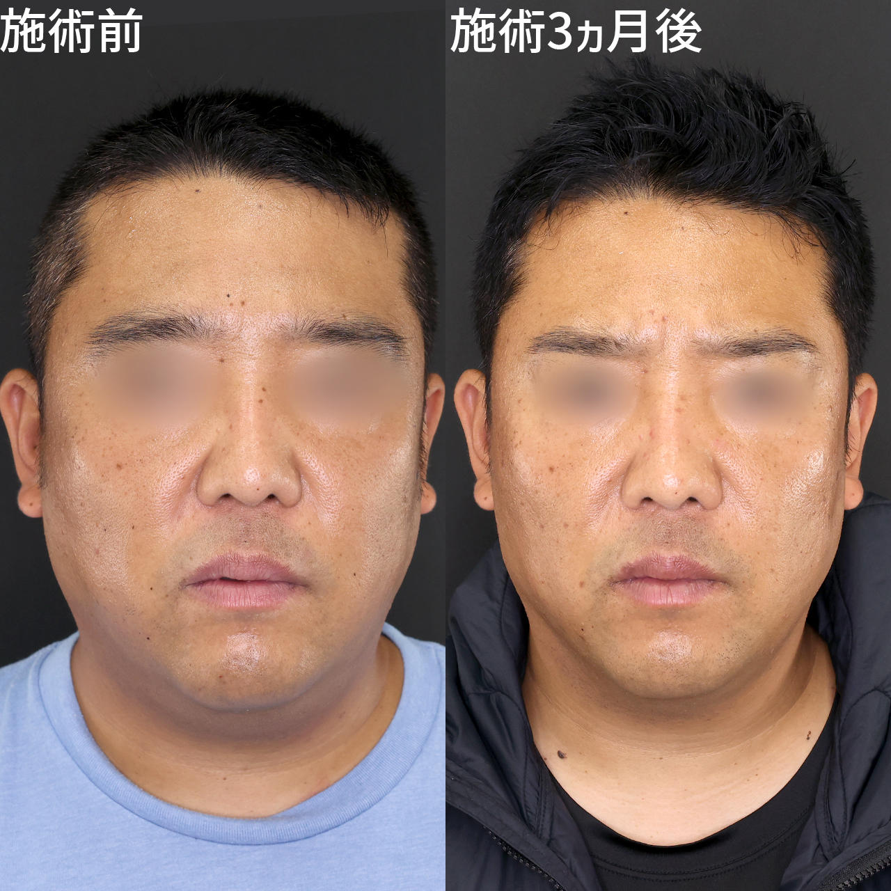 男性の小顔整形もDr.もりもり!顔の脂肪をスッキリ【メンズ美容】