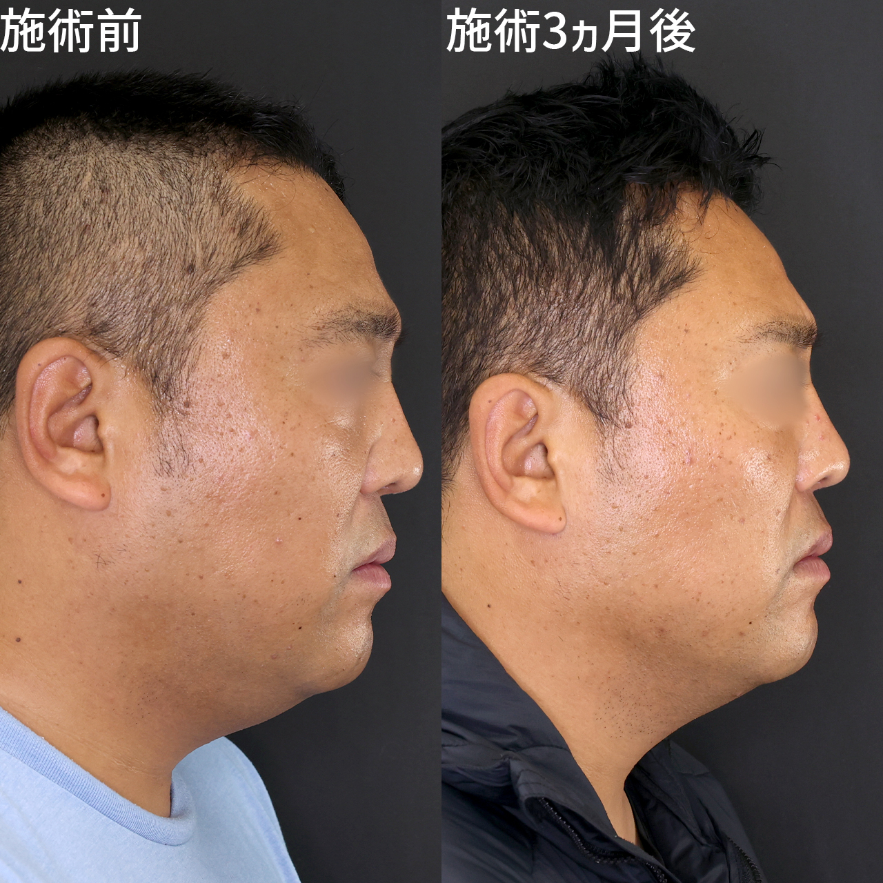 TAC式 ツヤ肌コラーゲンリフト®/Lラインファット除去(エラ下脂肪除去)/顔の脂肪吸引の症例写真 施術前後