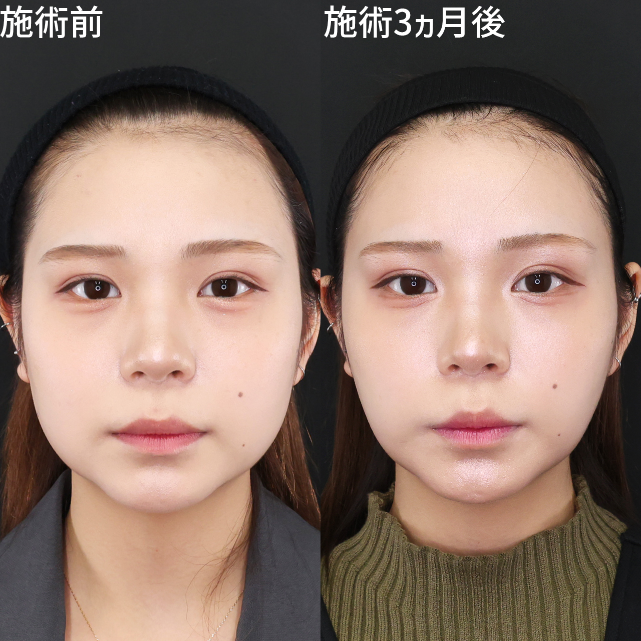 TAC式 ツヤ肌コラーゲンリフト®/ジョールファット除去/顔の脂肪吸引の症例写真 施術前後