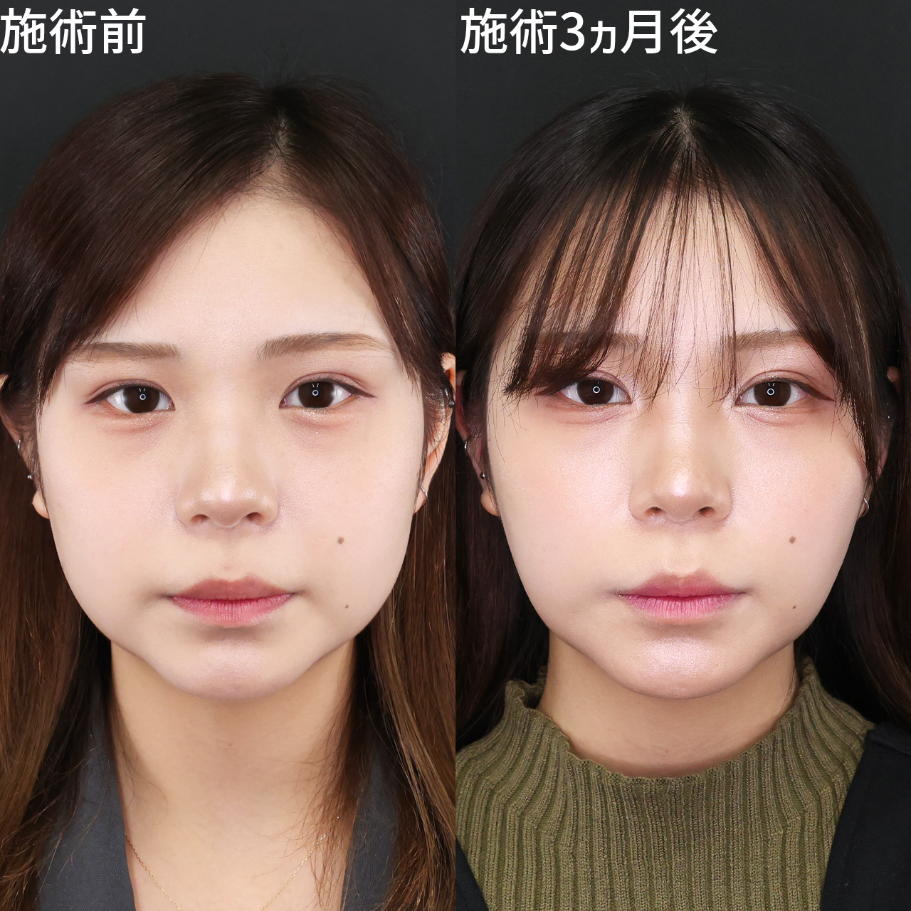 TAC式 ツヤ肌コラーゲンリフト®/ジョールファット除去/顔の脂肪吸引の症例写真 施術前後