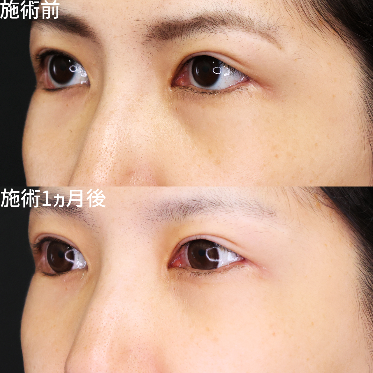 目立つ傷ゼロ！印象を明るくするクマ取り