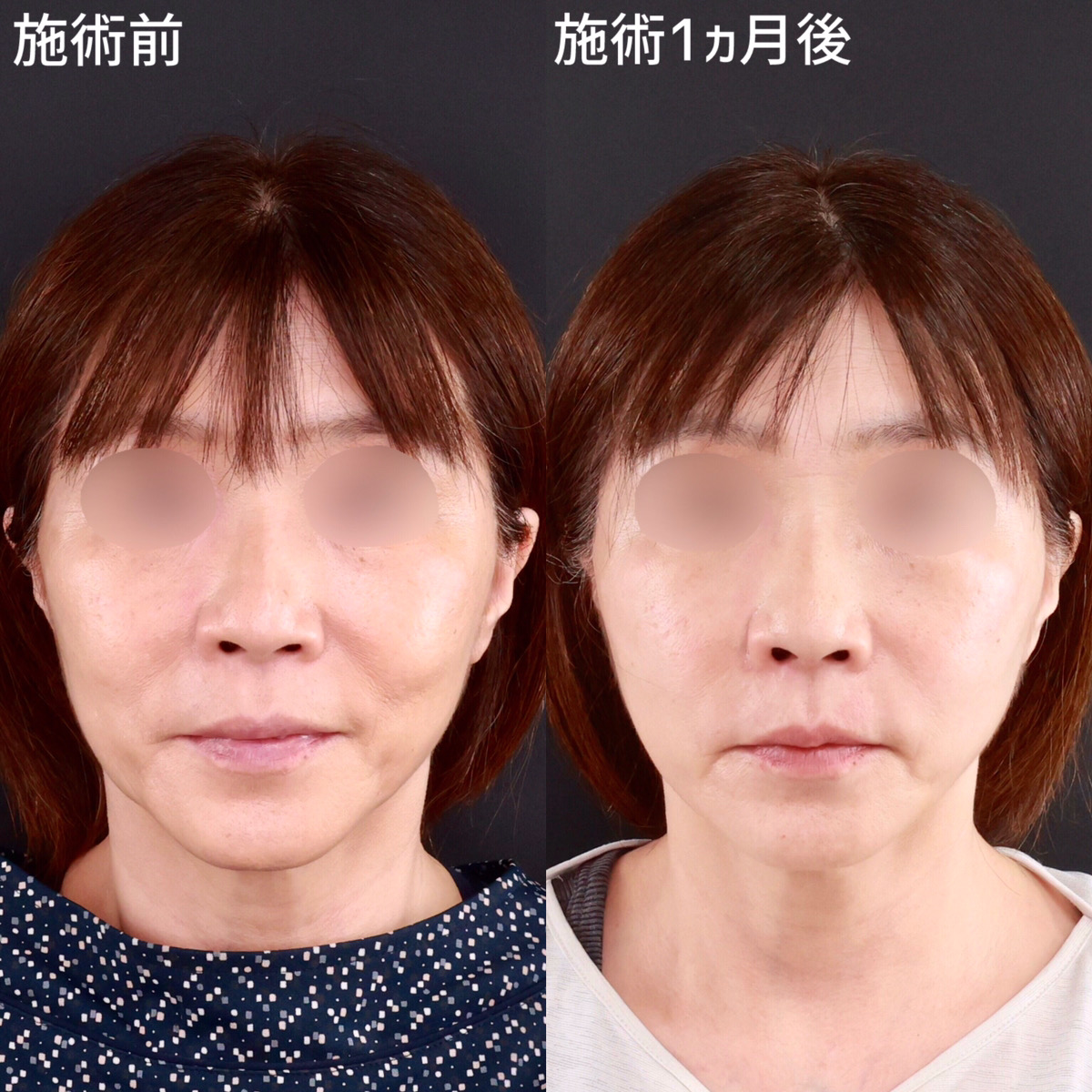 TAC式 ツヤ肌コラーゲンリフト®/ほうれい線のヒアルロン酸注射の症例写真 施術前後