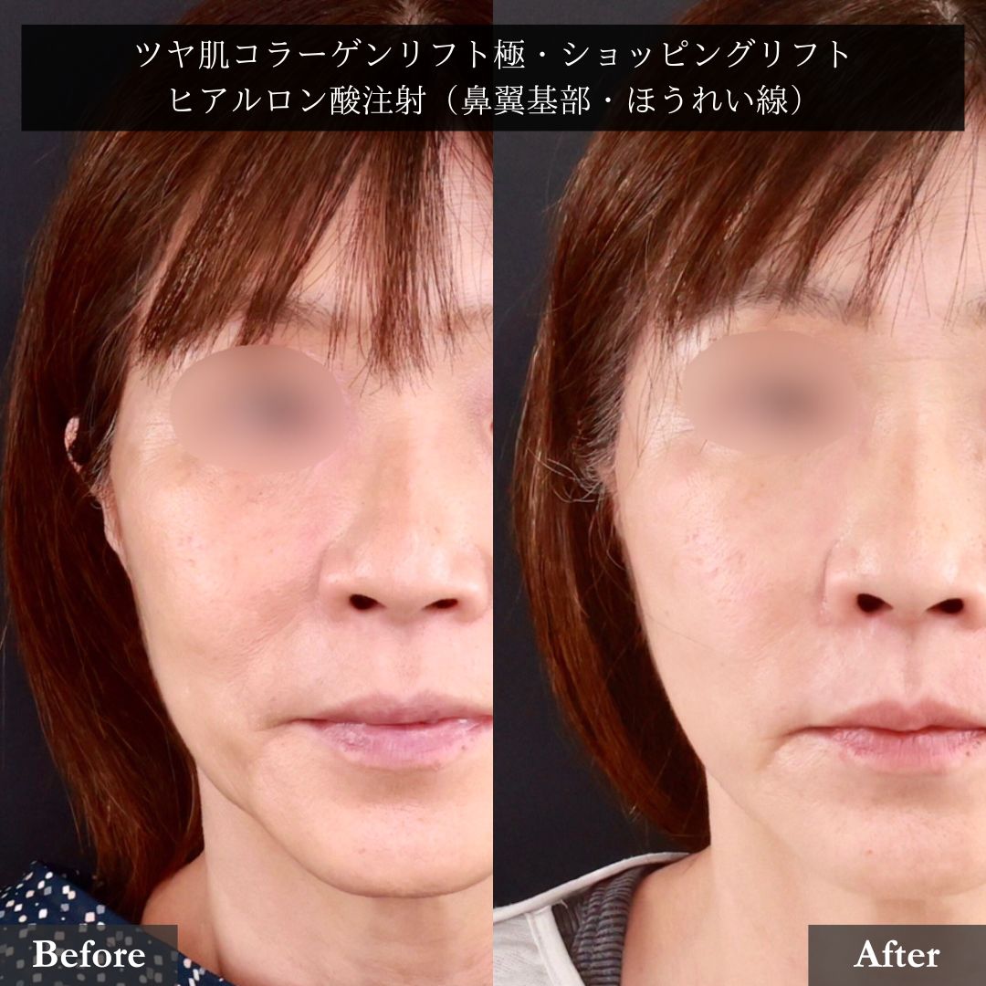 TAC式 ツヤ肌コラーゲンリフト®/ほうれい線のヒアルロン酸注射の症例写真 施術前後
