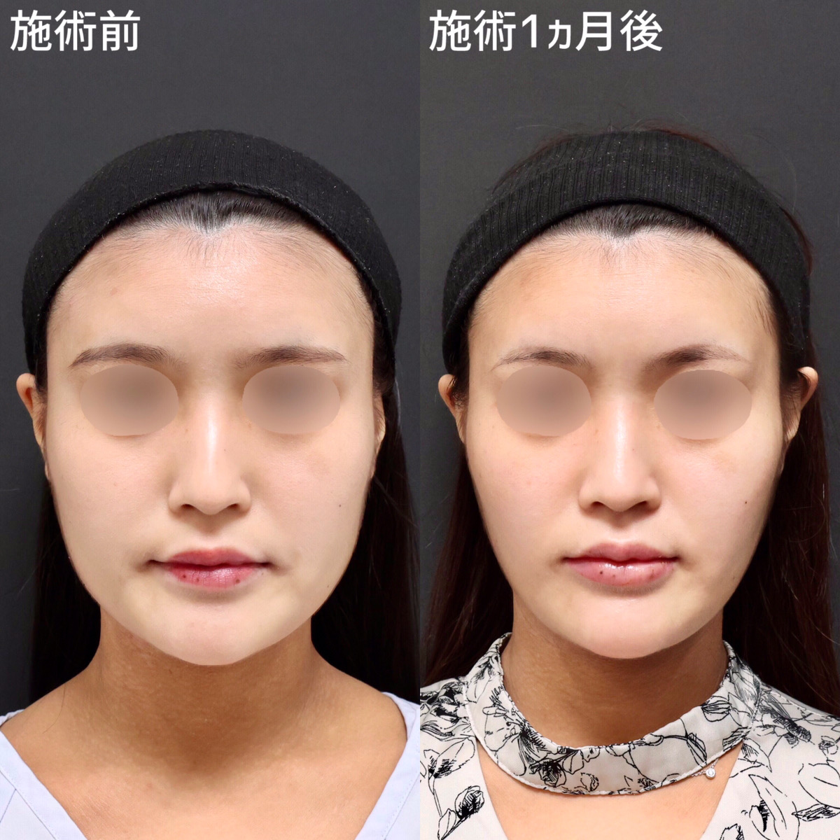 【小顔整形】糸リフトと脂肪除去でお顔の余白をなくす