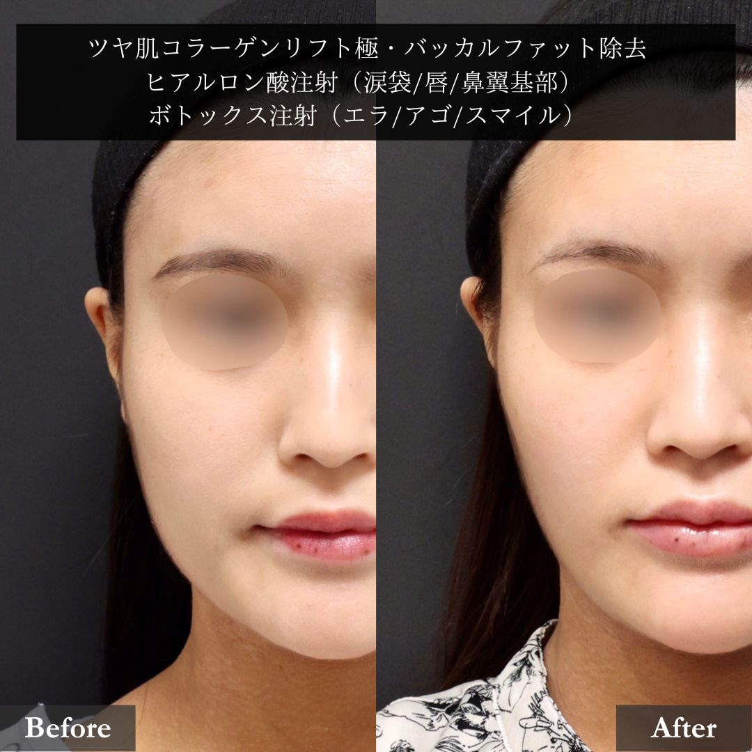 TAC式 ツヤ肌コラーゲンリフト®/バッカルファット除去/エラボトックス注射の症例写真 施術前後
