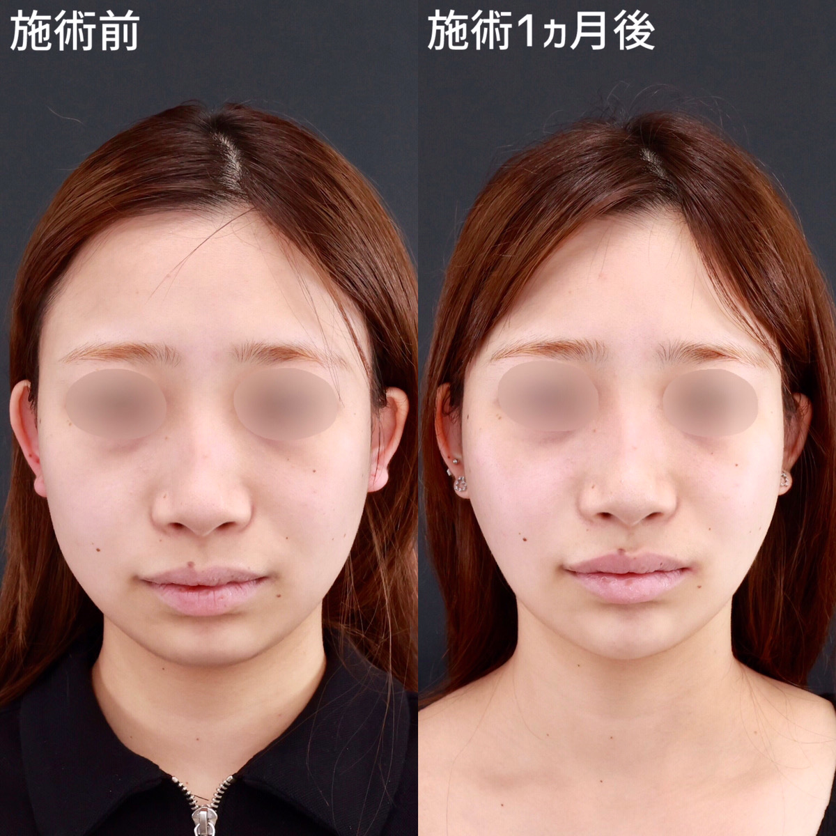 【小顔整形】糸リフトと脂肪吸引で自信の持てる輪郭に！