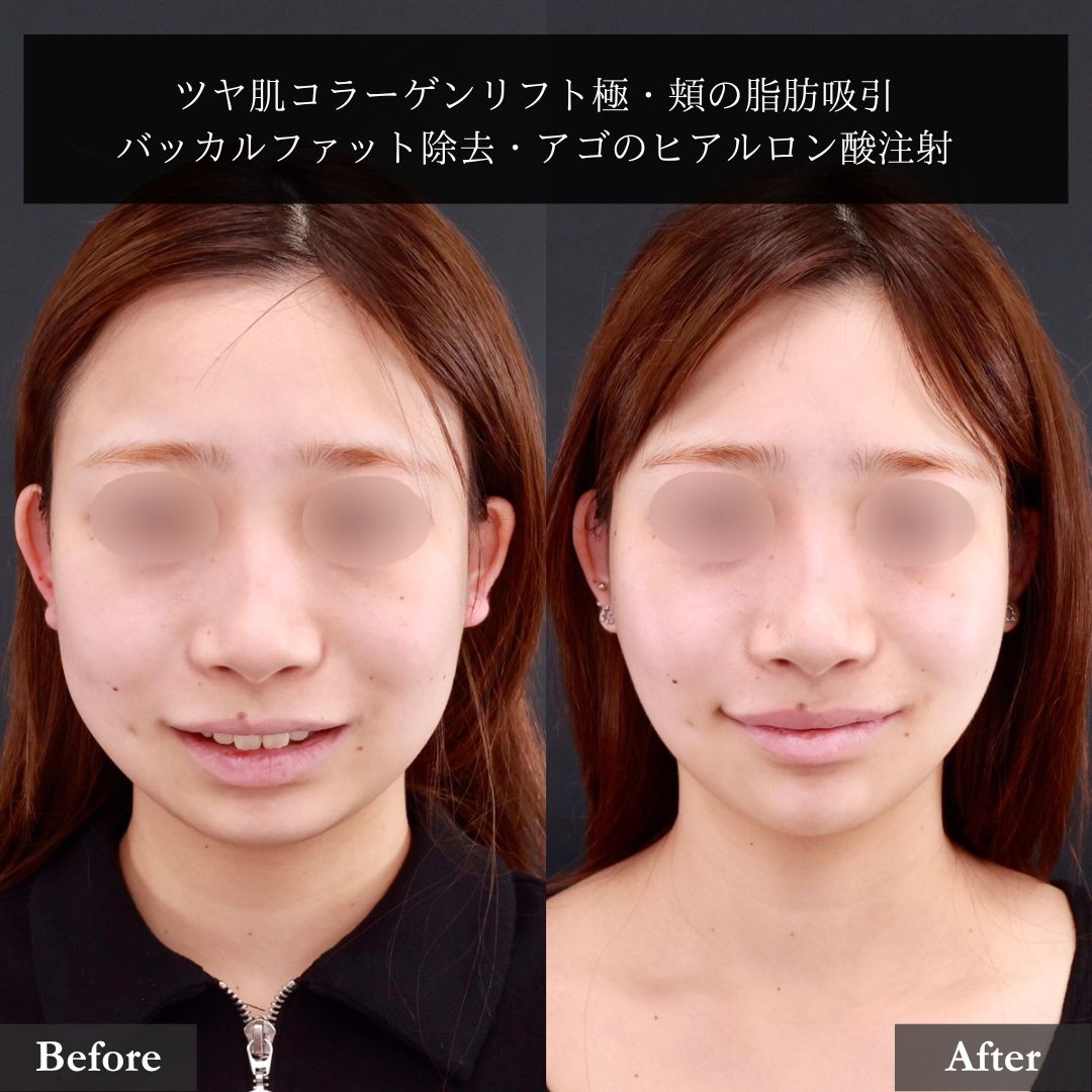 TAC式 ツヤ肌コラーゲンリフト®/顔の脂肪吸引/バッカルファット除去の症例写真 施術前後 