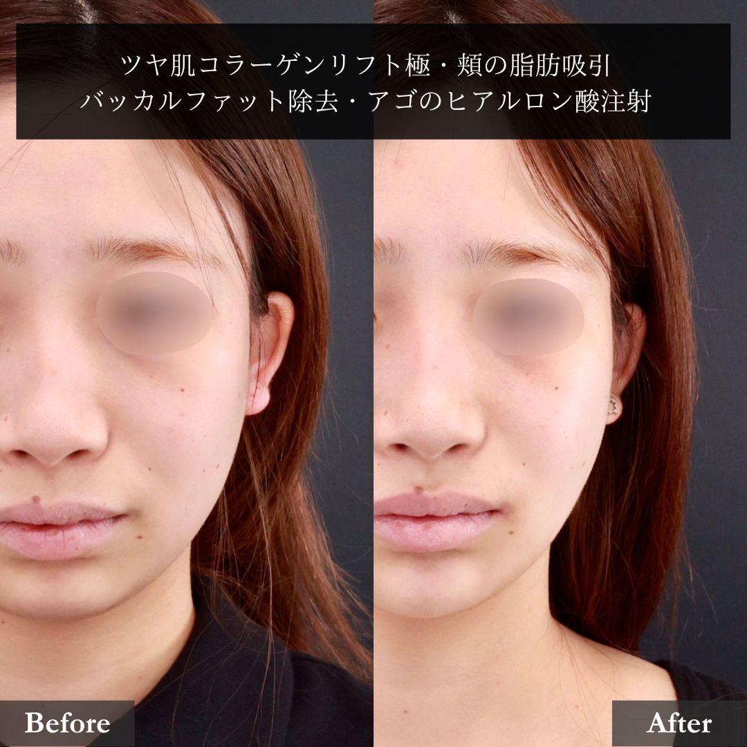 TAC式 ツヤ肌コラーゲンリフト®/顔の脂肪吸引/バッカルファット除去の症例写真 施術前後 