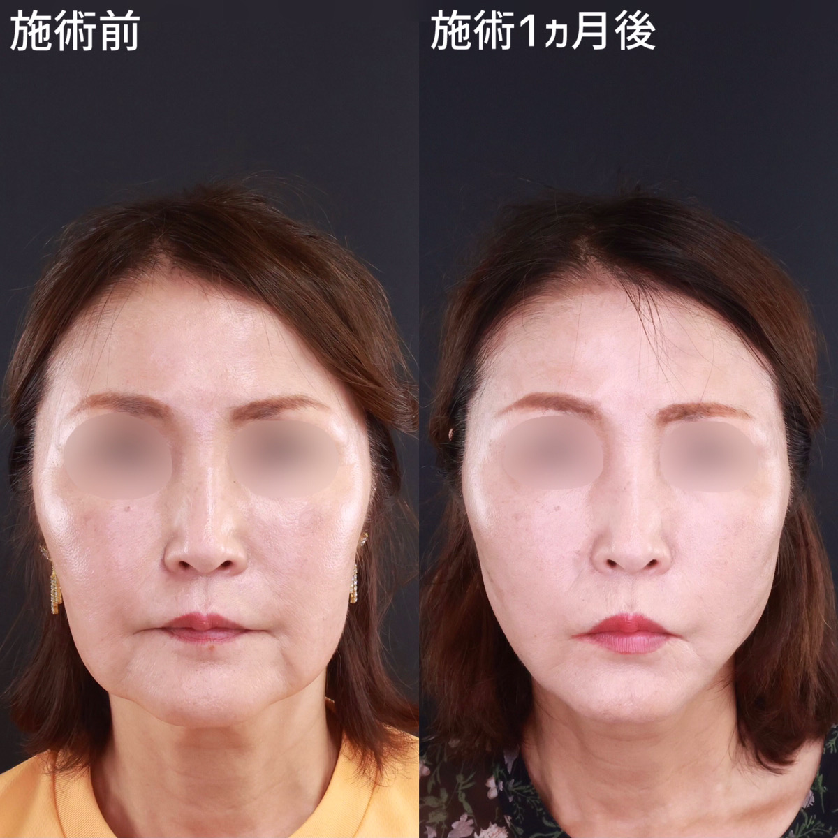 TAC式 ツヤ肌コラーゲンリフト®/ジョールファット除去の症例写真 施術前後