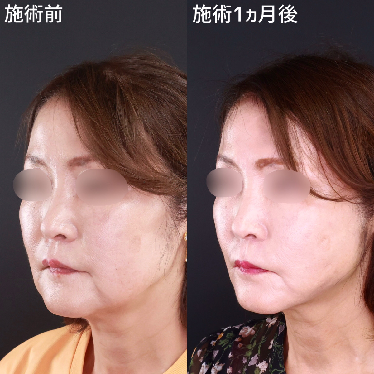 TAC式 ツヤ肌コラーゲンリフト®/ジョールファット除去の症例写真 施術前後