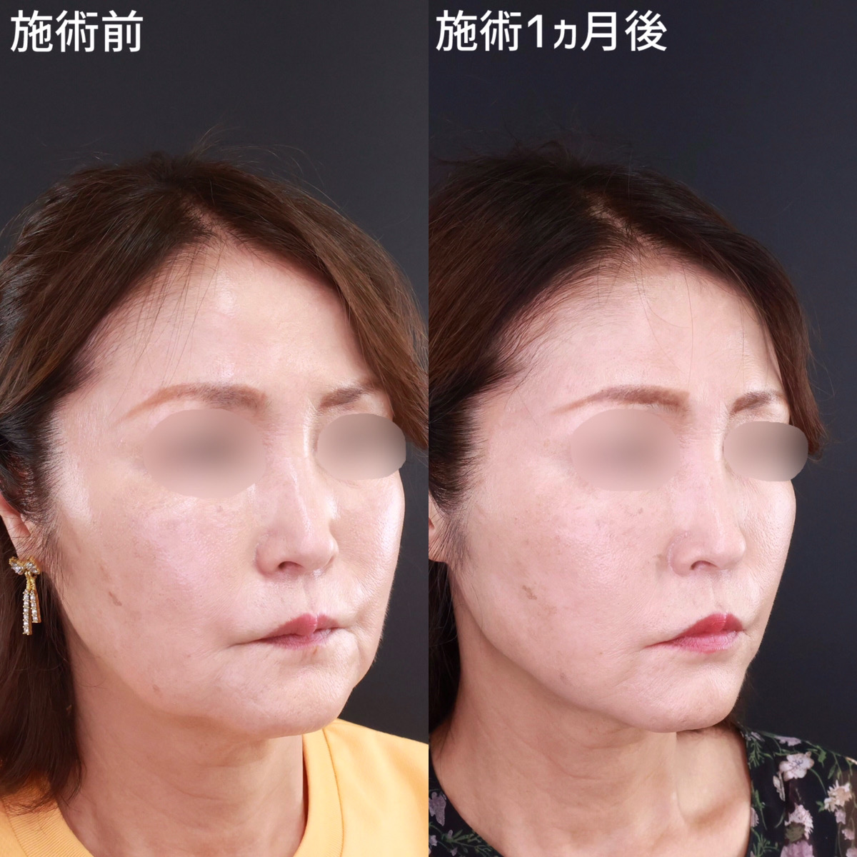 TAC式 ツヤ肌コラーゲンリフト®/ジョールファット除去の症例写真 施術前後