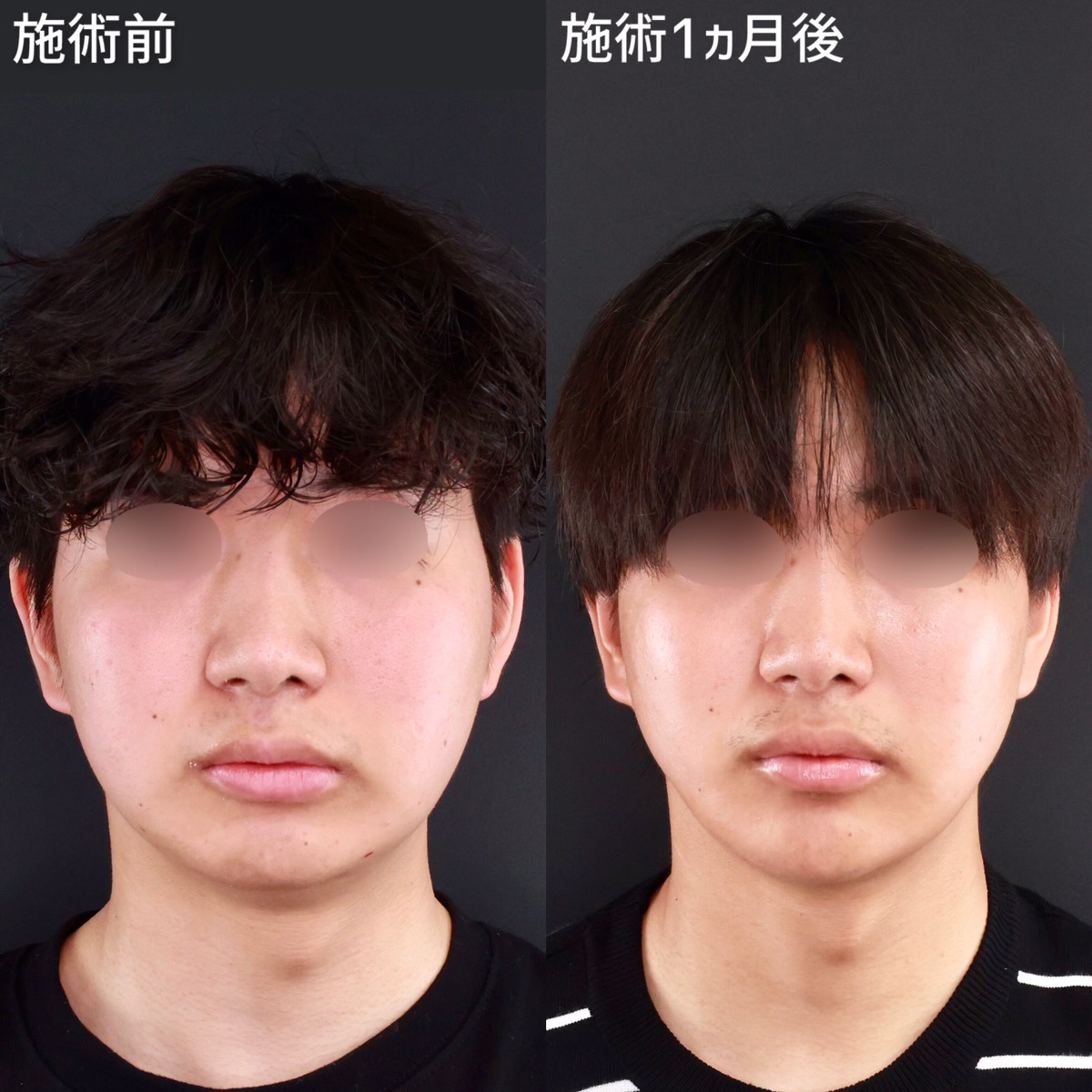 バッカルファット除去/顔の脂肪吸引/顎のヒアルロン酸注射の症例写真 施術前後